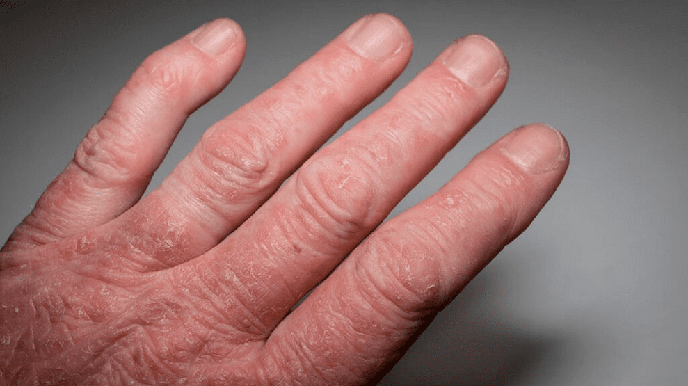 Psoriasis photo, symptômes, traitement ; sur la tête, les ongles et d — free download